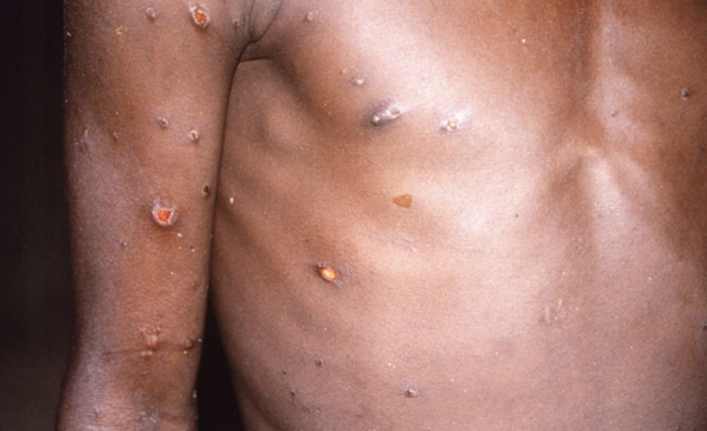monkeypox outbreak spreads